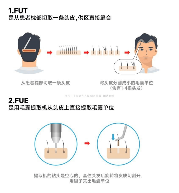 科普｜植发手术后多久能长出头发？做一次就行吗？