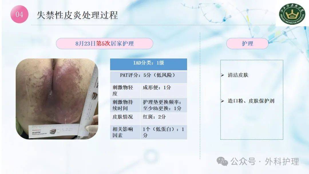 【ppt】一例骨盆骨折失禁性皮炎患者的案例分享