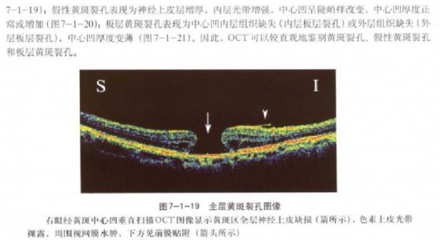 眼底病黄斑裂孔