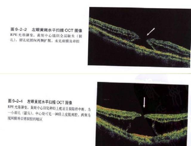 眼底病黄斑裂孔