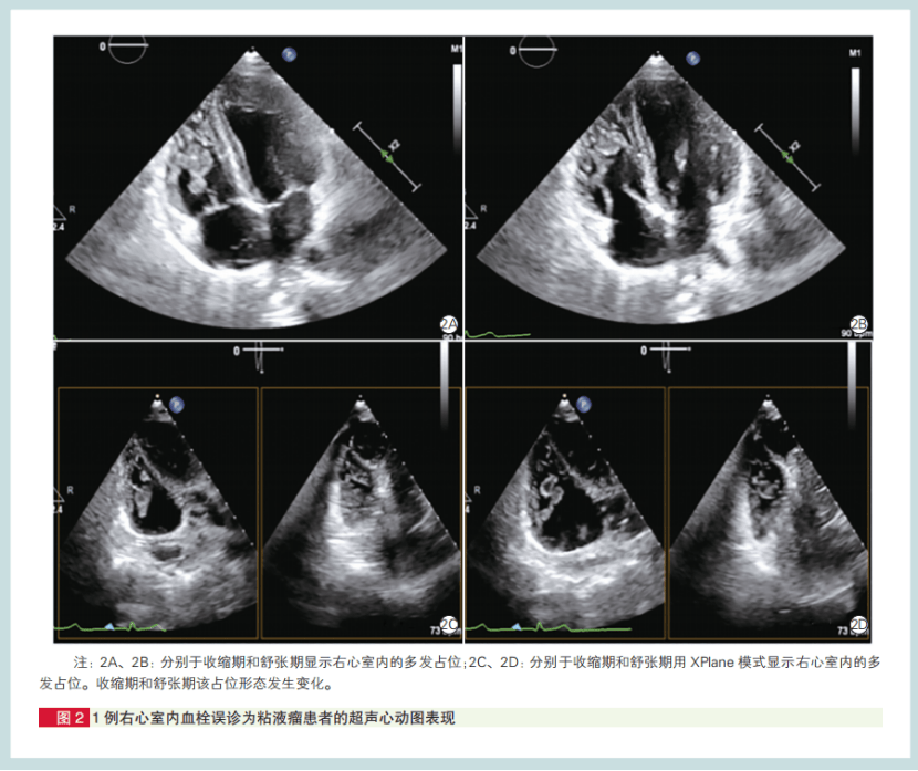 部分小儿心脏肿瘤超声心动图有特征！阜外医院经验总结(图2)