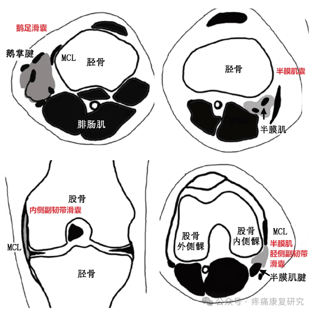 髌前滑囊炎图片