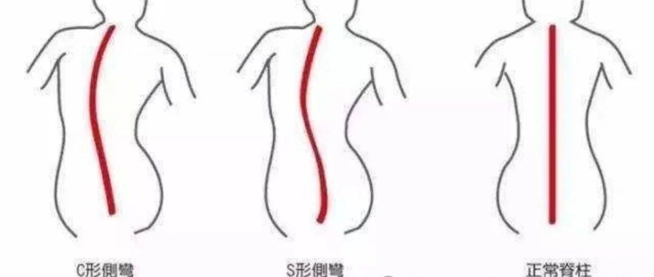 姿势不注意,一不小心就成了“剃刀背”!_脊椎_严重_孩子