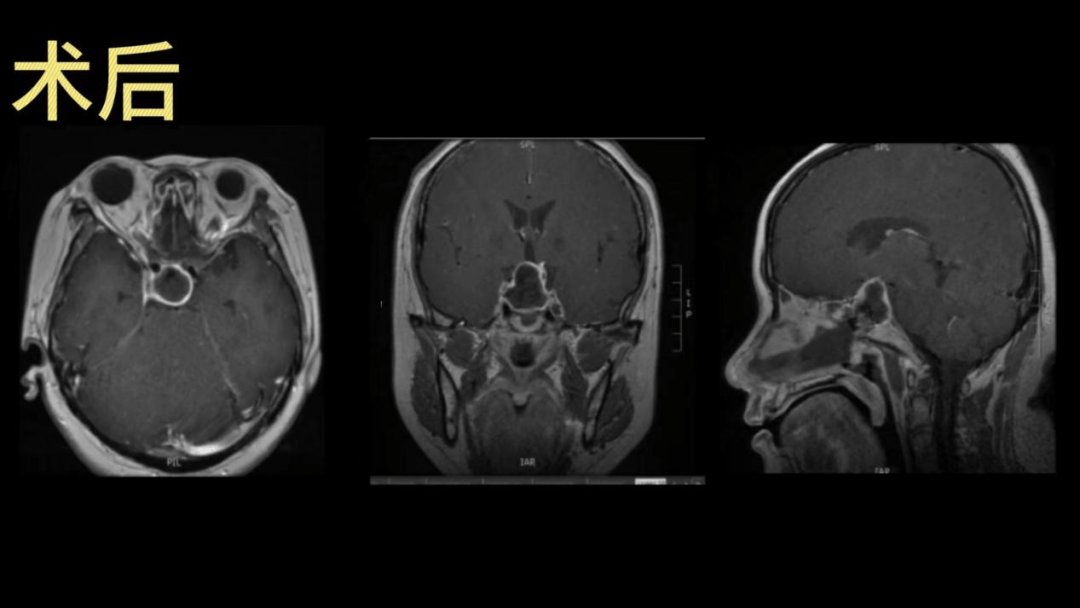 垂体瘤微创手术的核武器神经内镜技术
