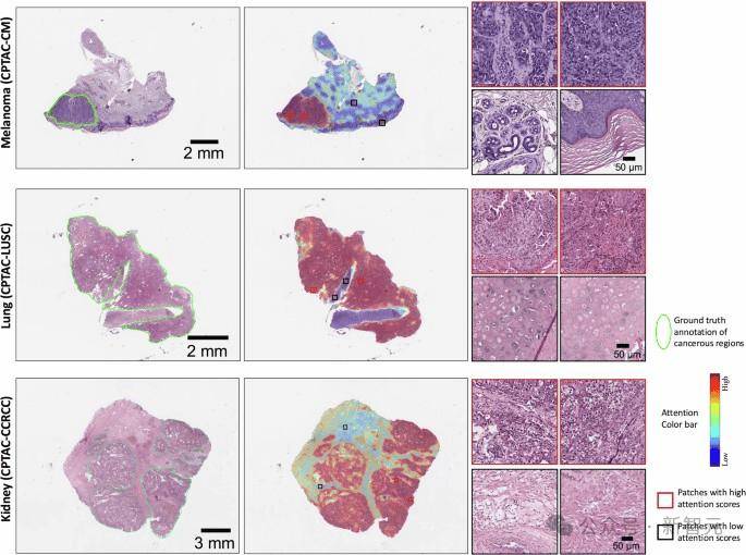 AI+医疗最新成果：哈佛推出癌症诊断AI，登上Nature！