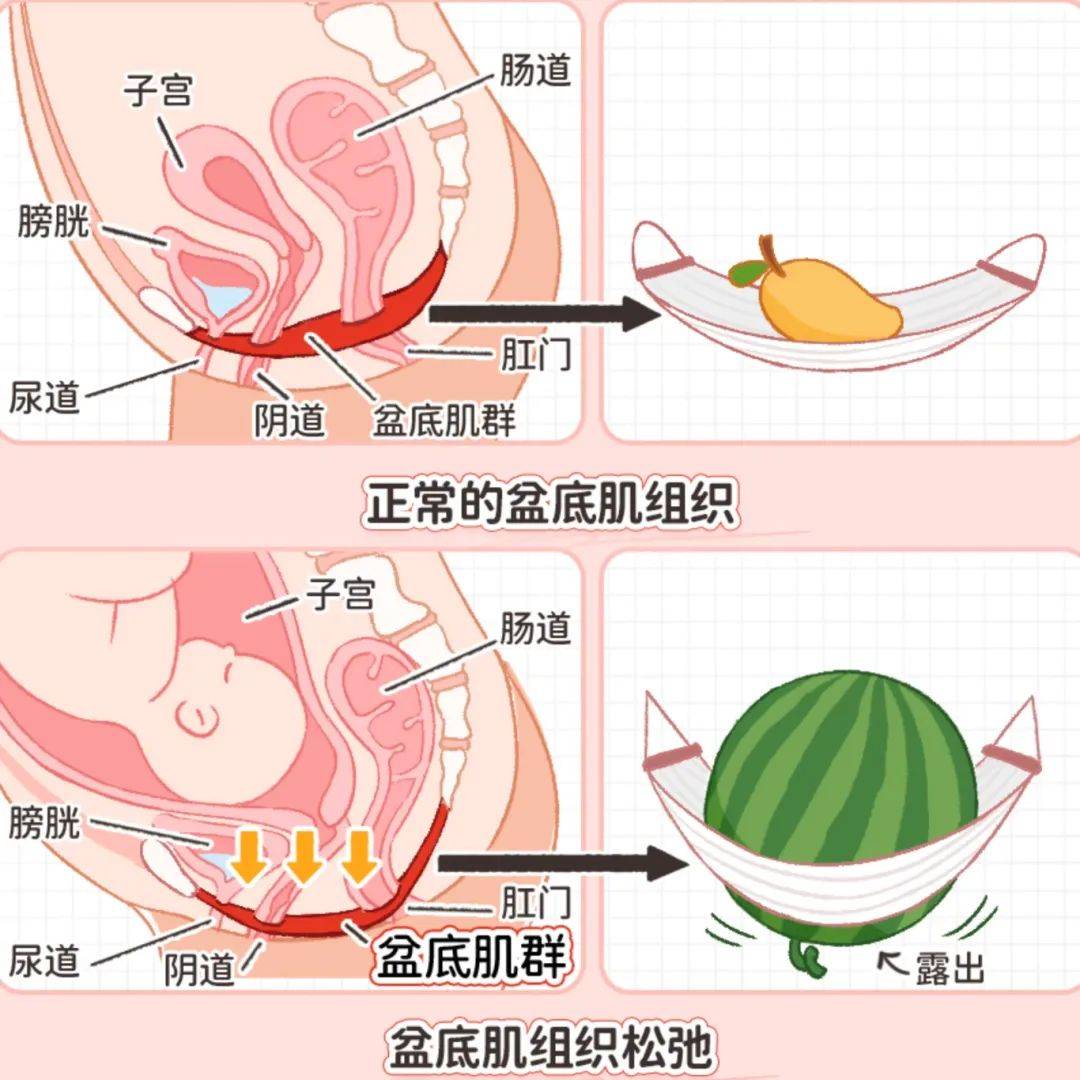 顺产撕裂恢复图图片