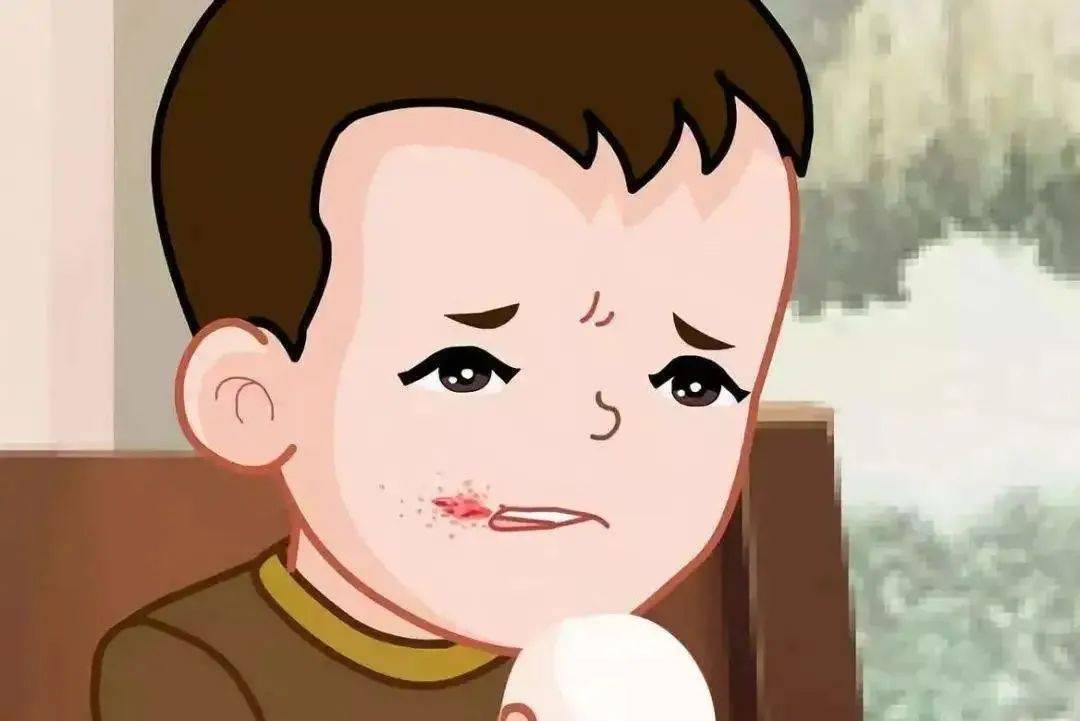 冬天孩子烂嘴角,可不是上火这么简单!