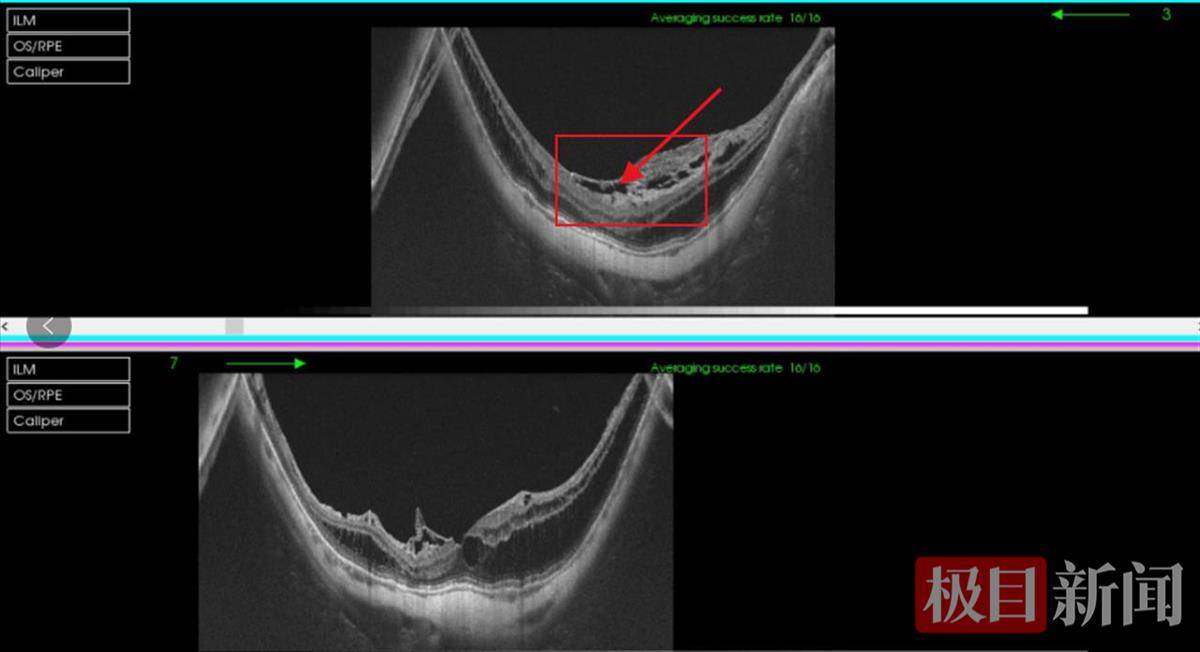 摘除手术的她植入眼内的人工晶体及张力环囊袋复合体已脱位至玻璃体腔