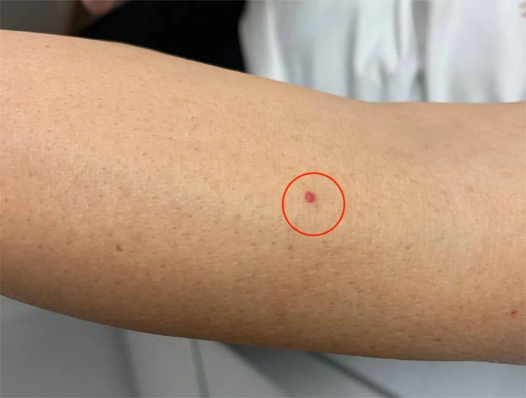 血管痣-01-温馨提示:看前先转发到"相亲相爱一家人"的群,提醒家人一起