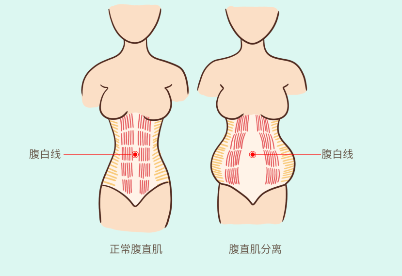 腹白线图片怀孕图片