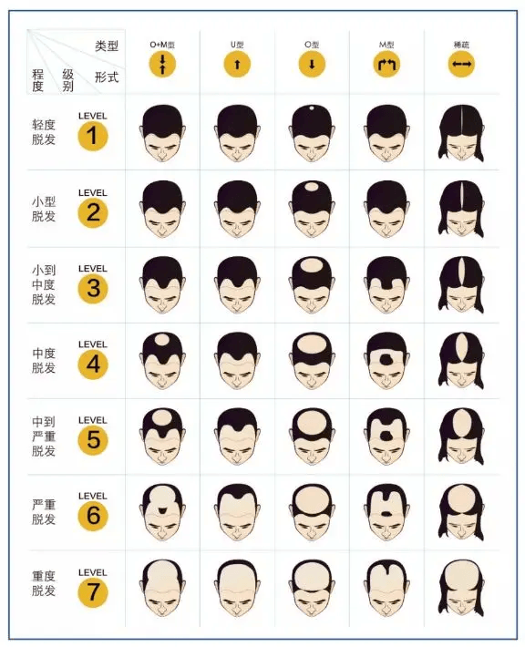 不植发,如何告别「地中海型男」和「秃头美少女?