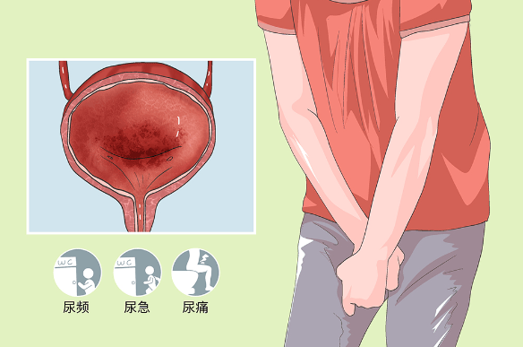 反复尿路感染困扰？揭秘背后的原因与解决方案！_细菌_尿道_治疗