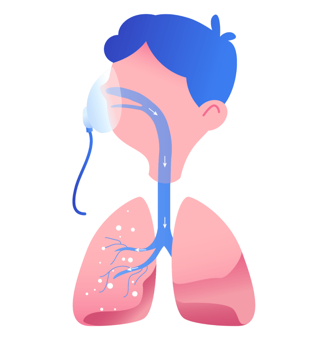 为何雾化治疗更适合儿童