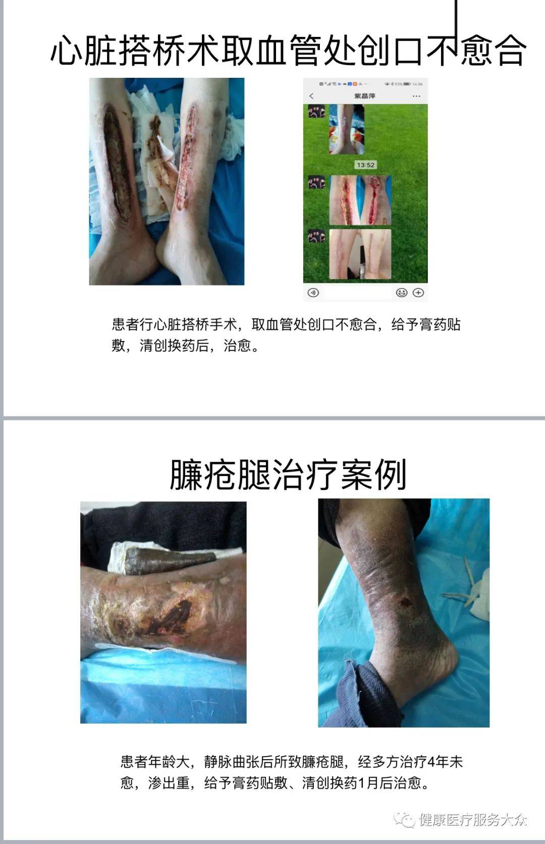 加速伤口愈合的突破性治疗方法