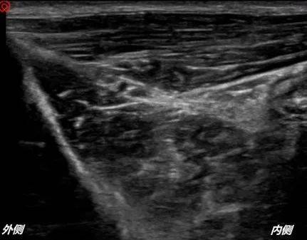 髂筋膜阻滞超声图领结图片