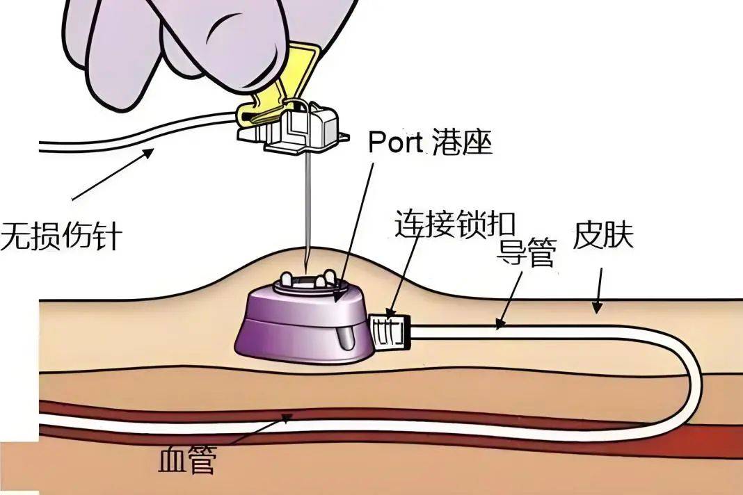 输液港结构示意图图片