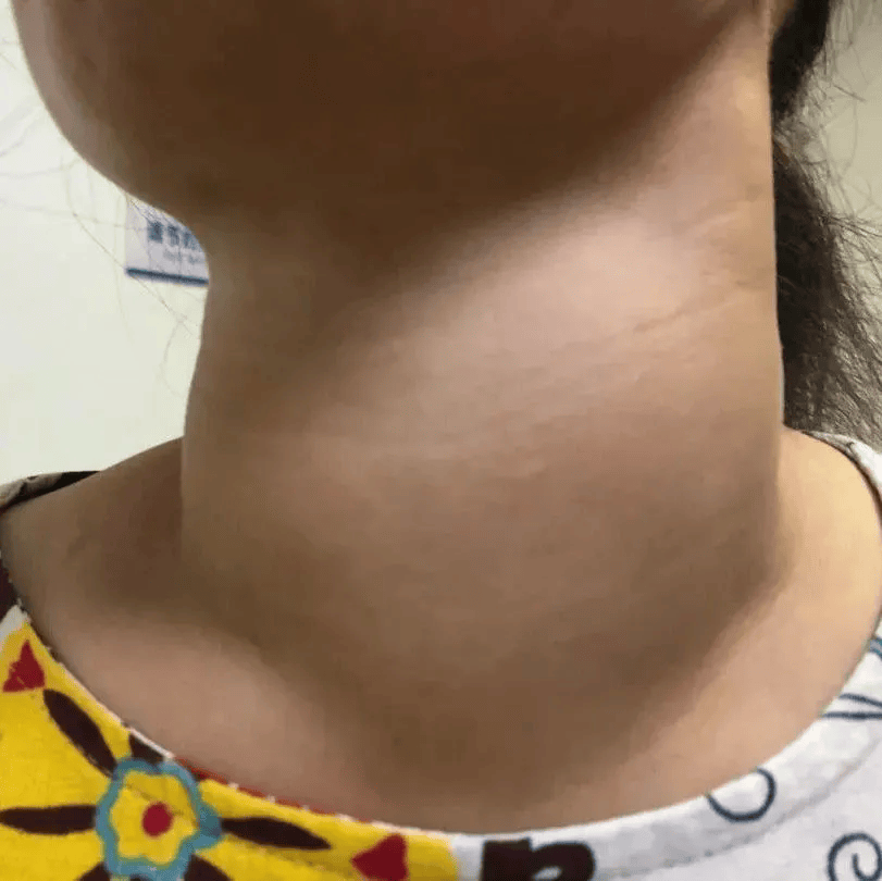 熬夜熬的是甲状腺寿命!女主播总凌晨睡觉,脖子熬粗了