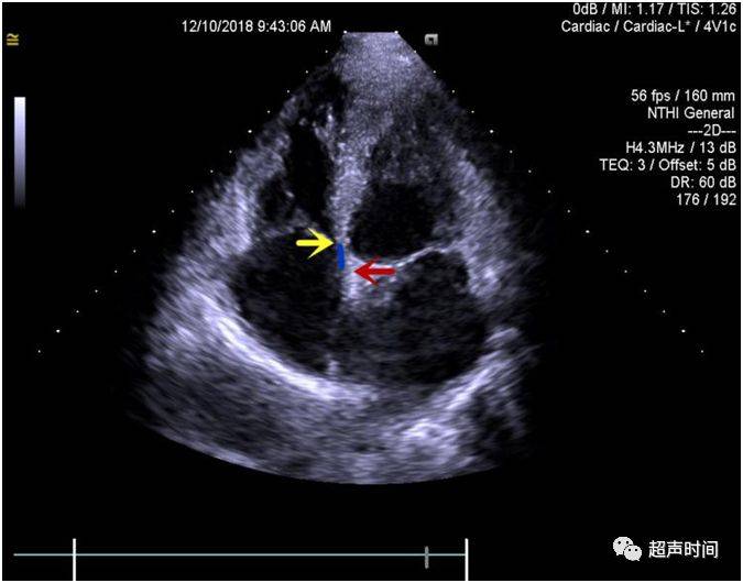 超声三尖瓣各瓣示意图图片