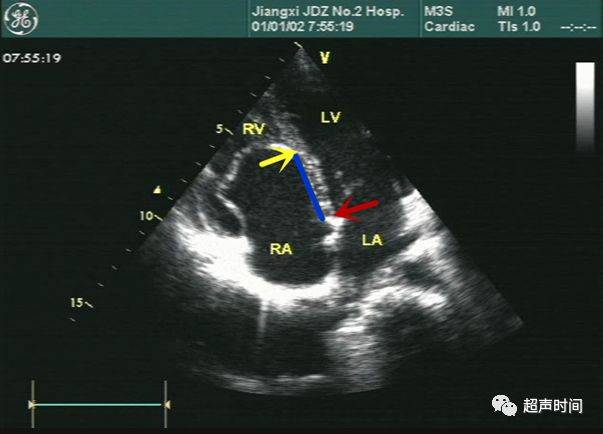 超声三尖瓣各瓣示意图图片