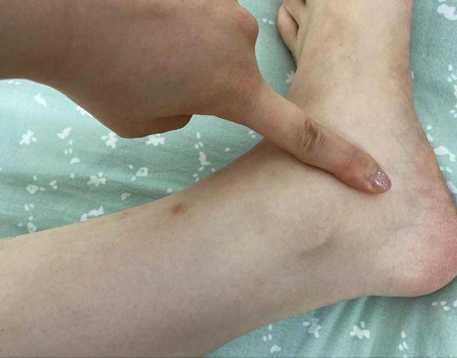 肾病加重前,双腿先发声!医生:若出现4个异常,再不重视就晚了