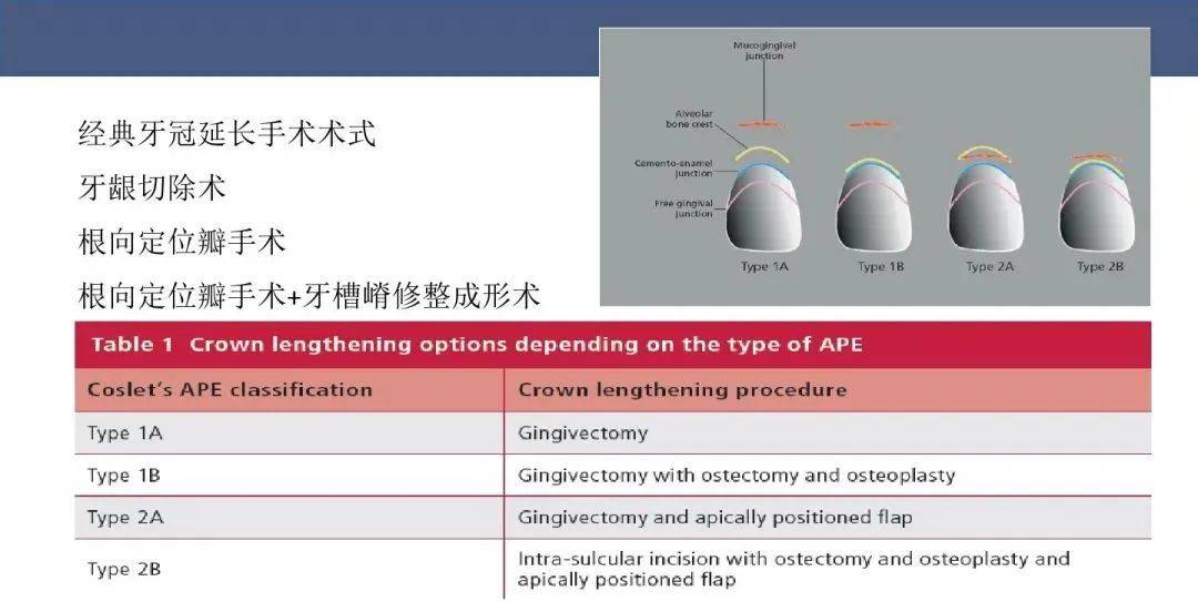 冠延长术的图解图片