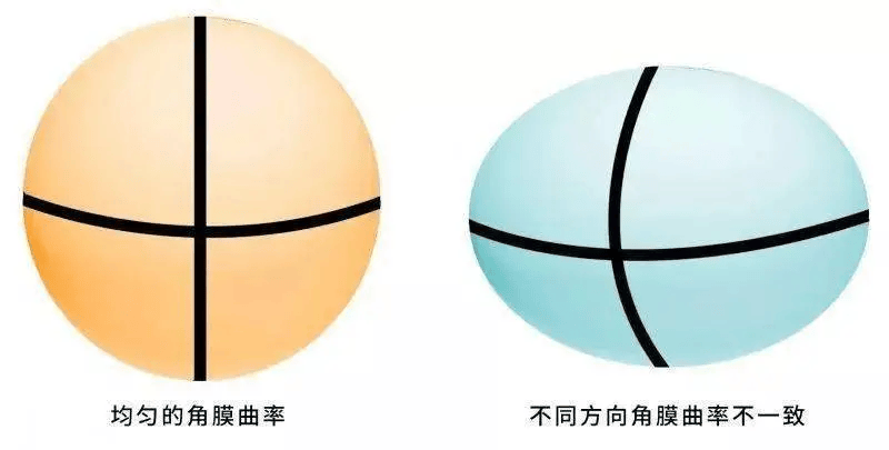 【科普】什么是角膜曲率？角膜曲率和近视有什么关系？