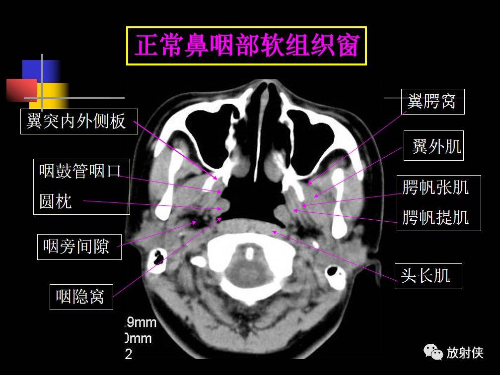 鼻咽部及ct的详细解剖图分析