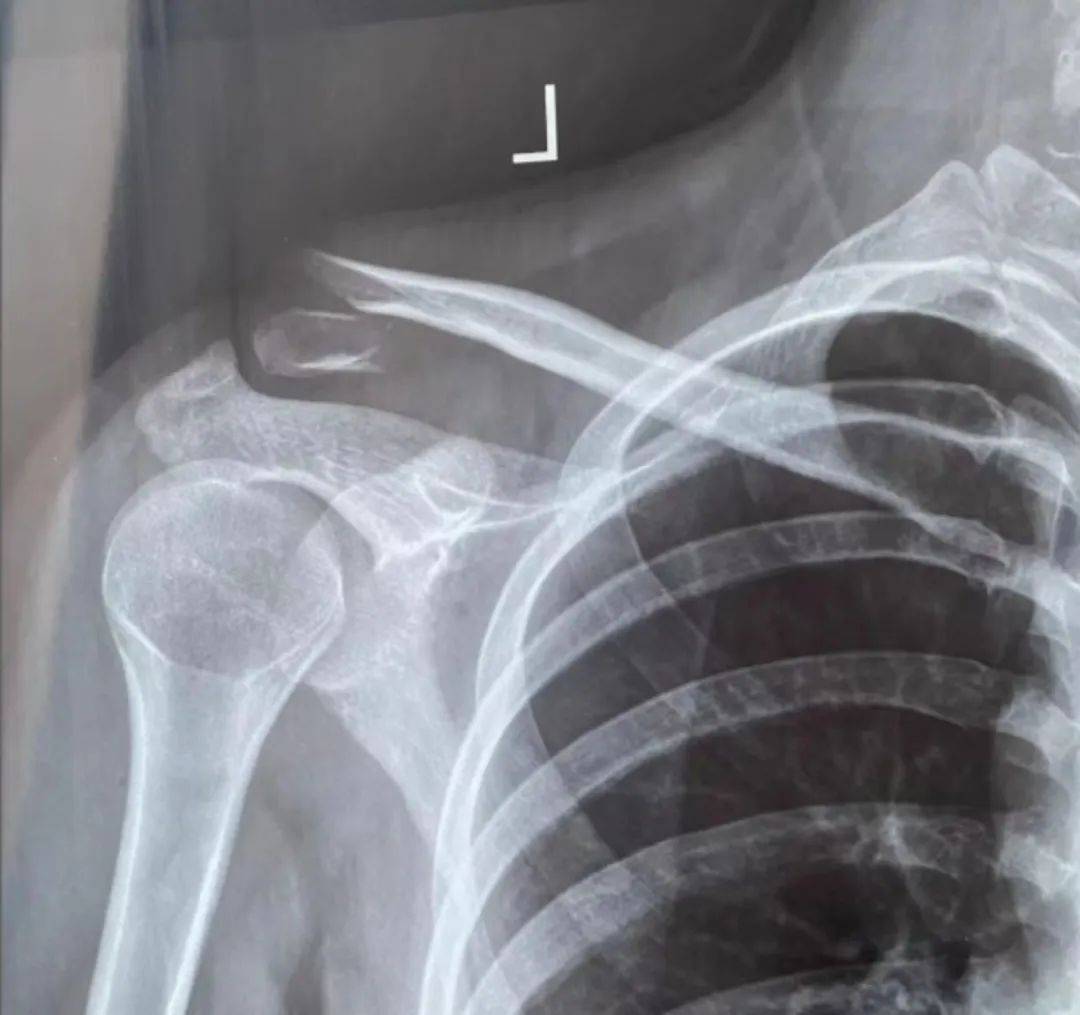 了解锁骨骨折,守护你的"肩头之翼"