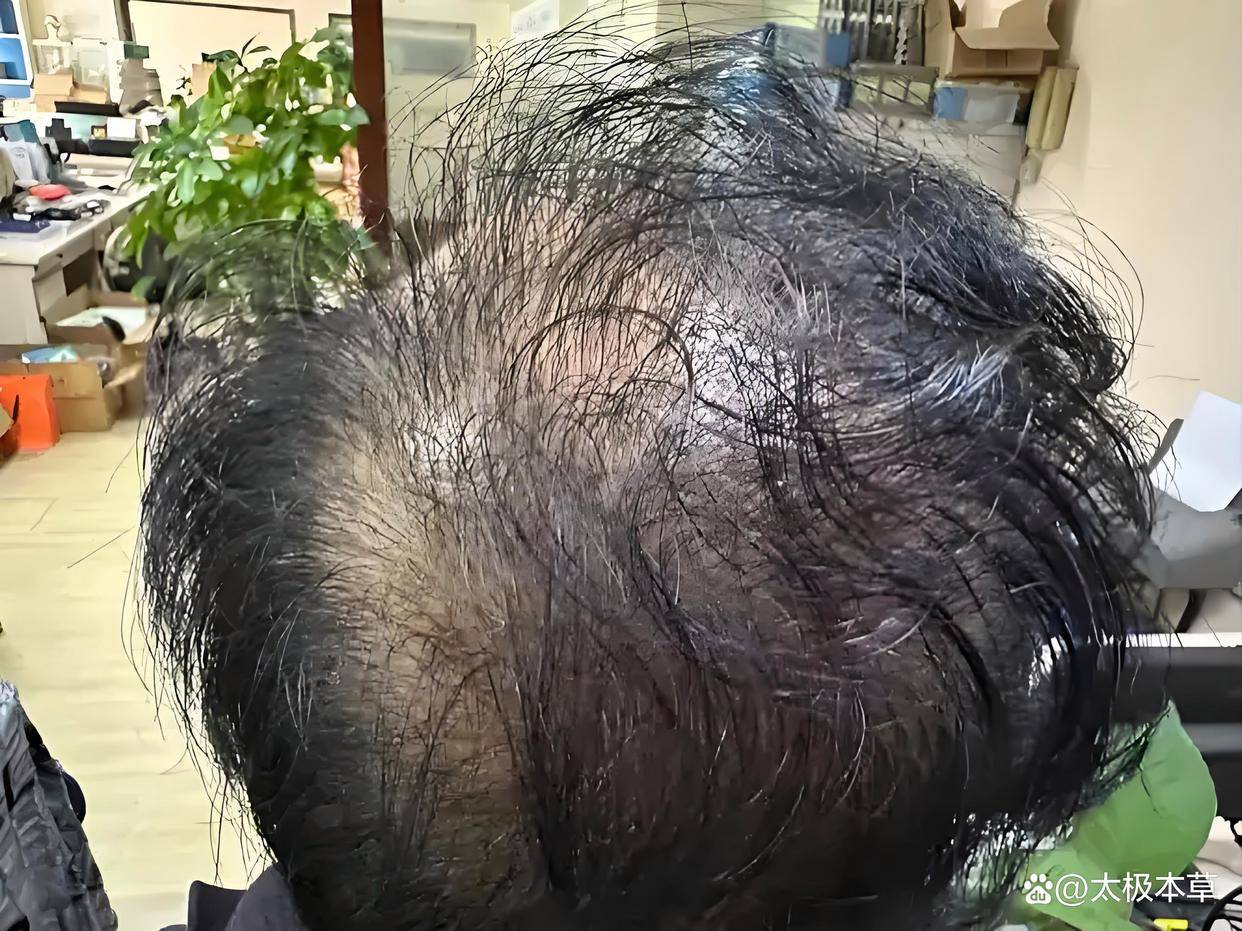 老中医揭秘：治脱发秘方，重生浓密秀发！