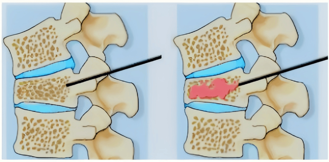 告别卧床困境,拥抱新生