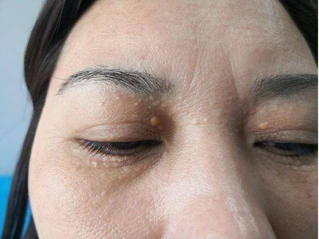 惊！眼睛细微变化或能判断高血脂是否远离脂肪肝 眼睛——高血脂与脂肪肝之间的健康警示器