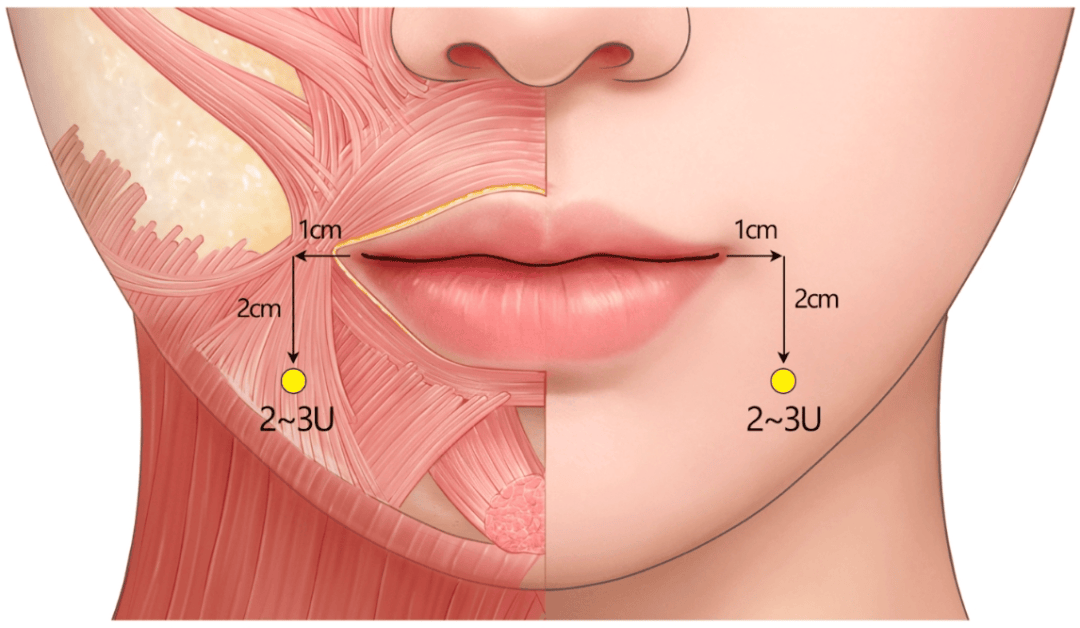 需避免过量注射或注射点过高,以防毒素扩散至邻近降下唇肌,导致唇部不