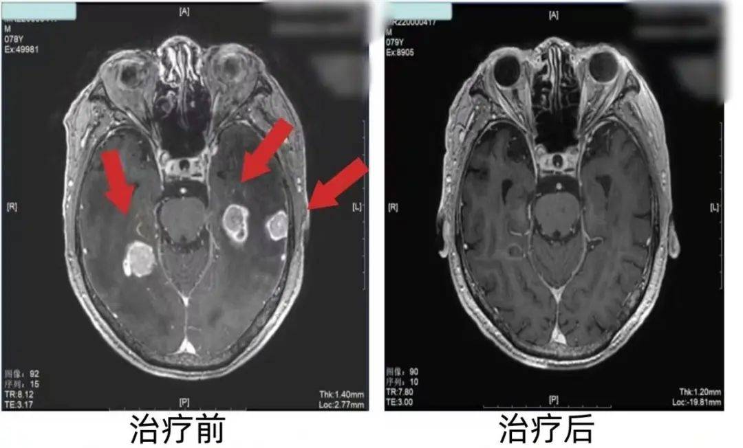 男子发现记忆力下降,一查竟是肺癌脑转移?医生:这些症状别忽视!