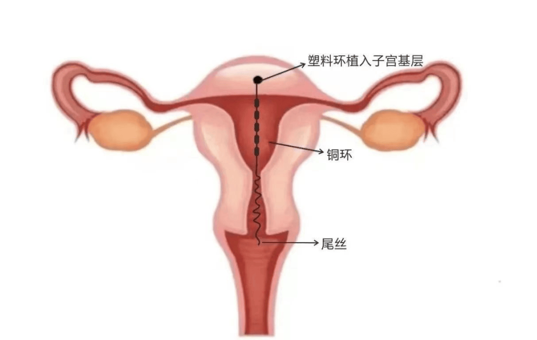 子宫腺肌症患者的福星