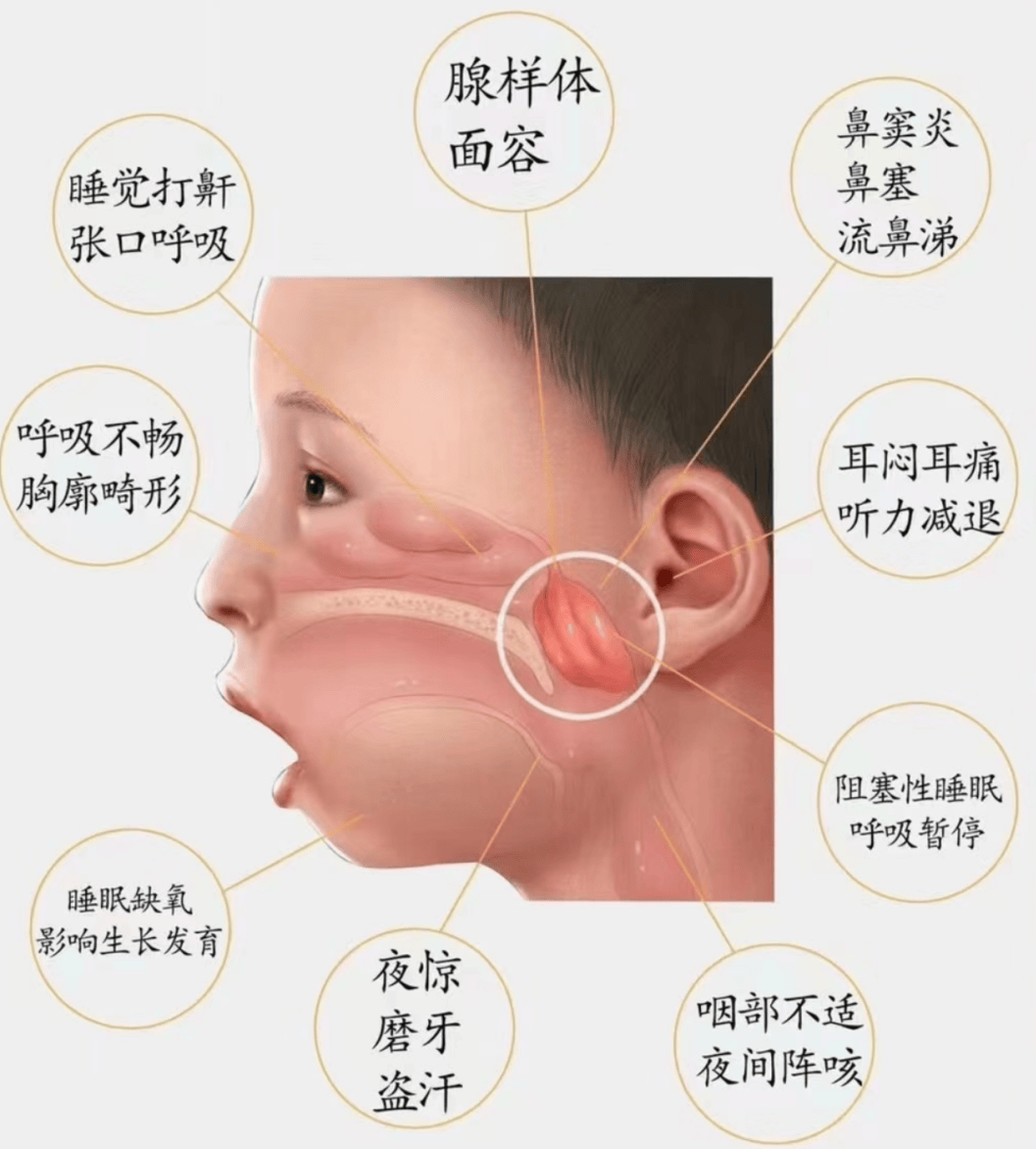警惕!腺样体肥大会悄悄"毁掉"孩子