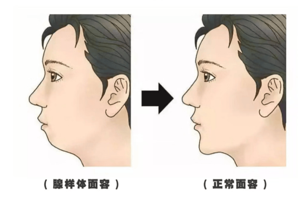 腺样体肥大会悄悄"毁掉"孩子