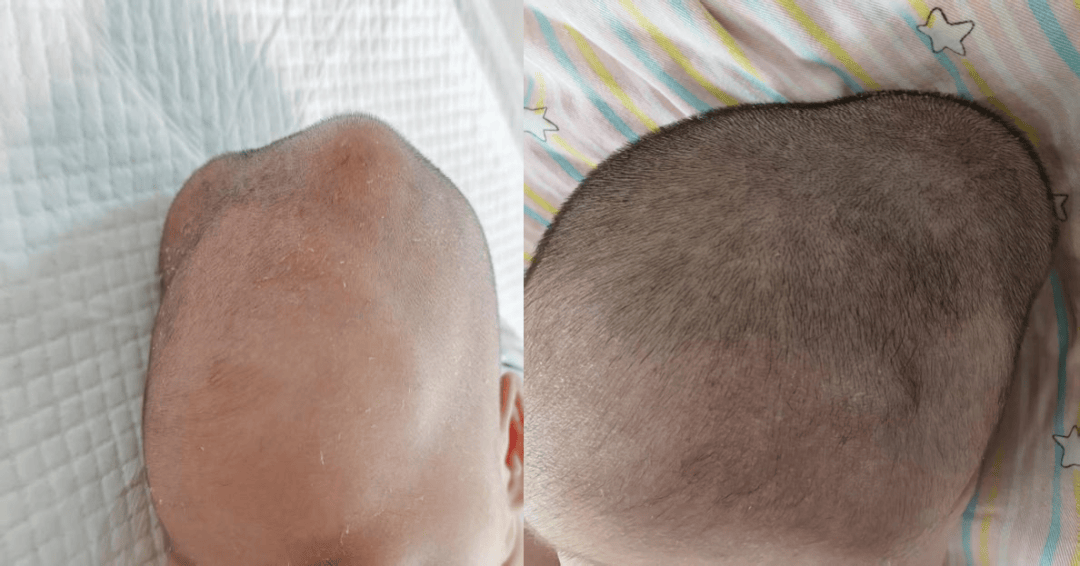 宝宝头上的"小犄角"是怎么了?