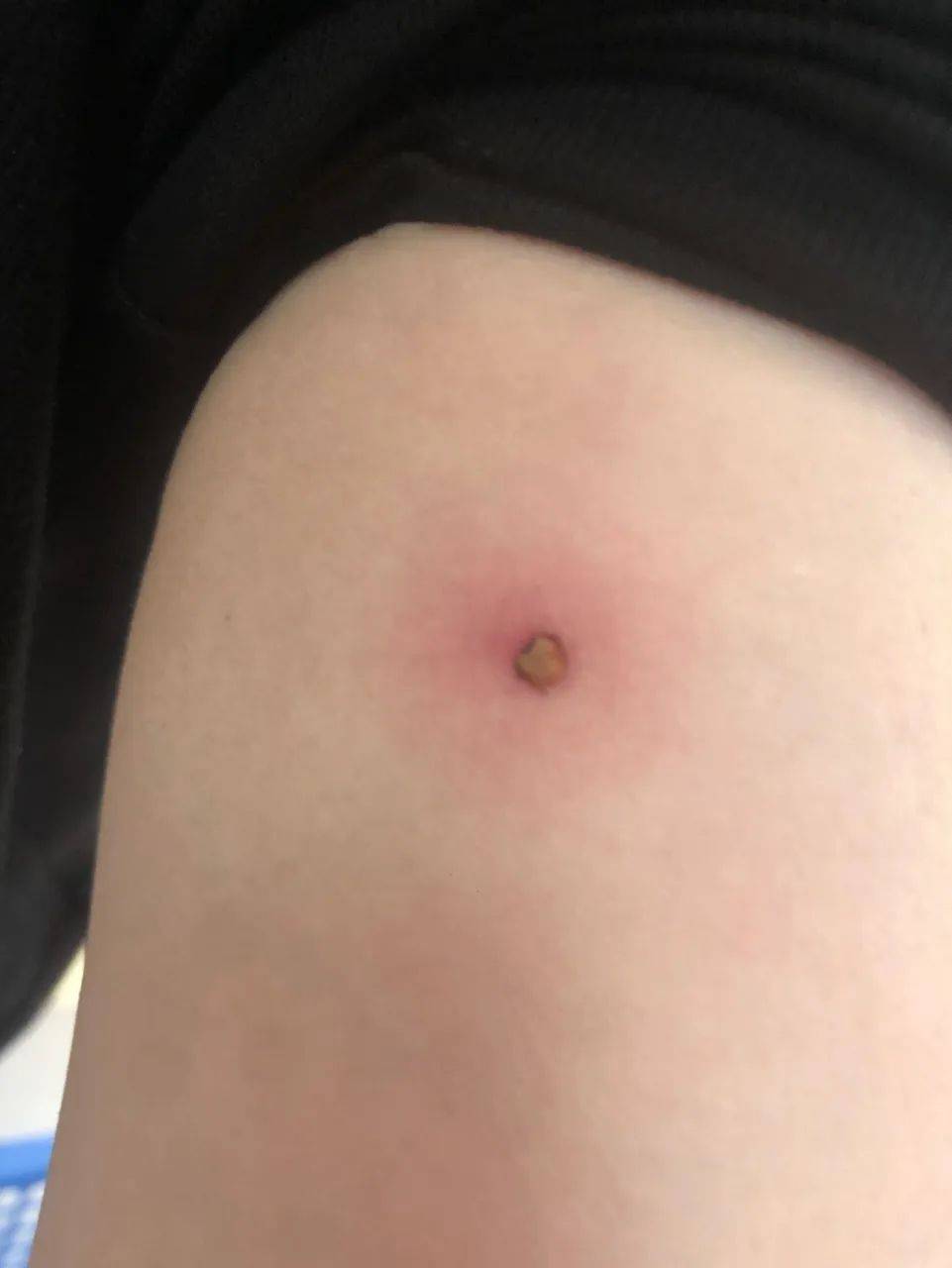 丨蜱虫咬伤后,你还用火烧杀虫吗