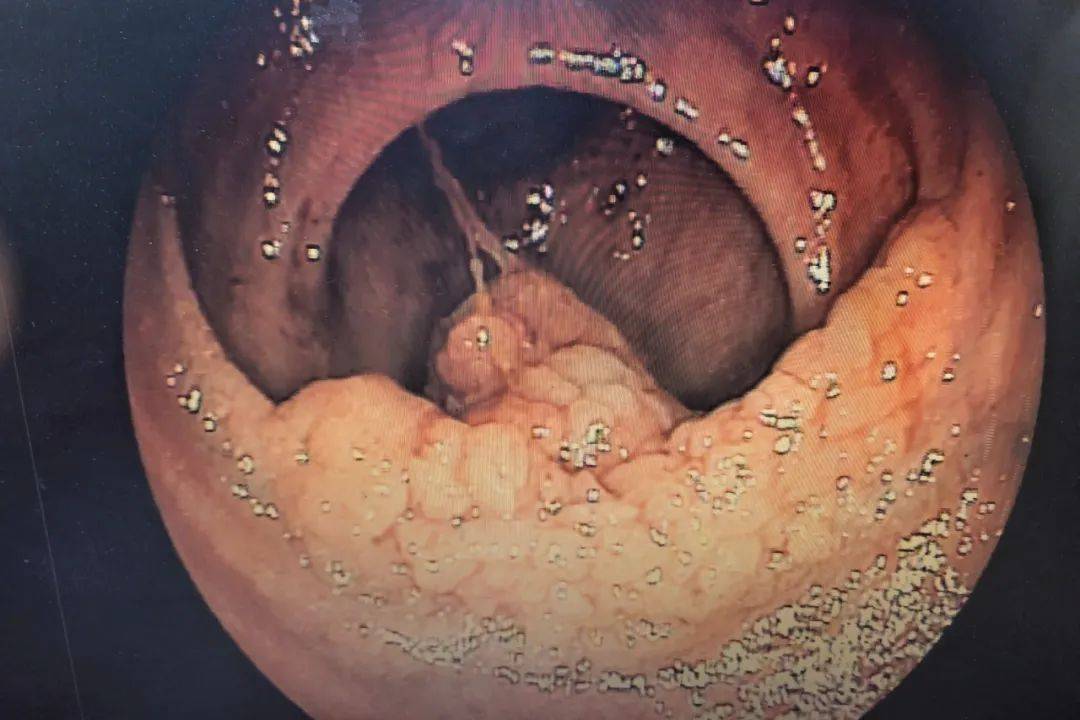 5cm 处直肠有3×4cm广基隆起病变,活检病理提示为癌前病变