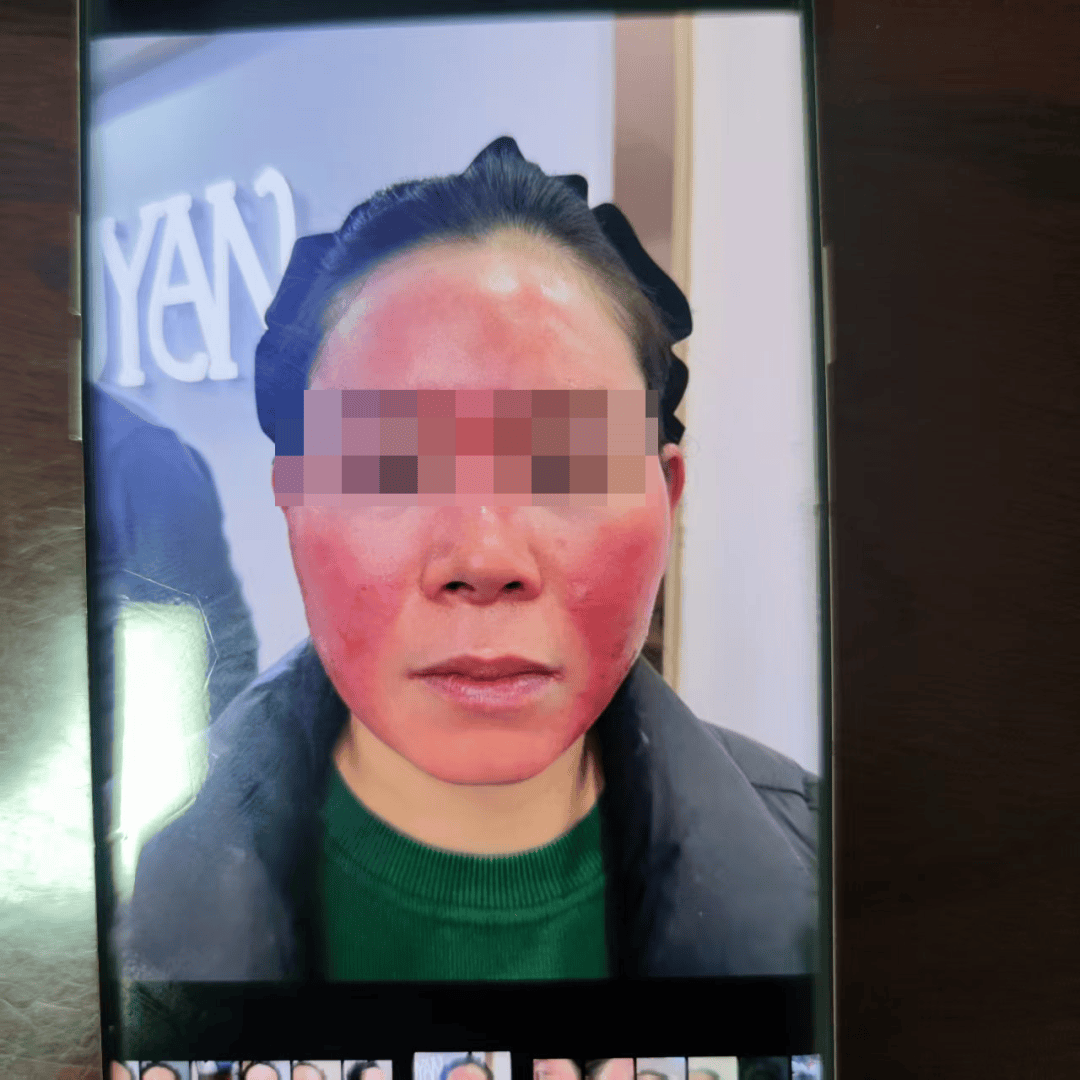 JN江南网址美容变“毁容”还遭拒赔看涪陵周女士如何获赔22万元(图1)