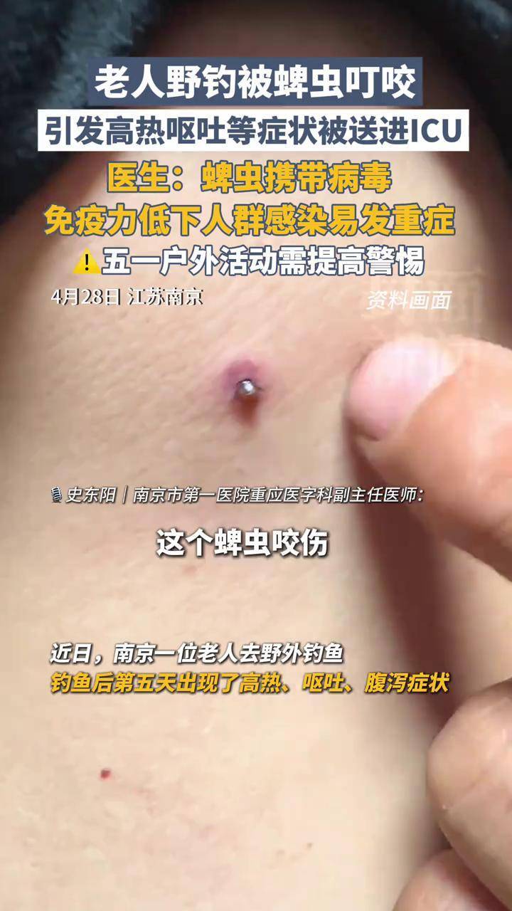 老人野钓被蜱虫叮咬,引发高热呕吐腹泻等症状被送进icu,医生:蜱虫携带