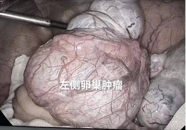 术中双侧卵巢肿瘤快速冰冻病理检查结果均为"卵巢交界性浆液性囊腺瘤