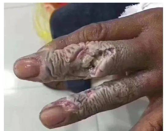 研究生进实验室后患癌,中毒,截肢.这些试剂看似无害,实则毒王