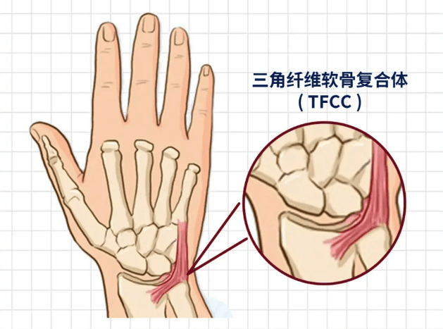 手腕痛?警惕tfcc损伤,康复科医生教你缓解办法