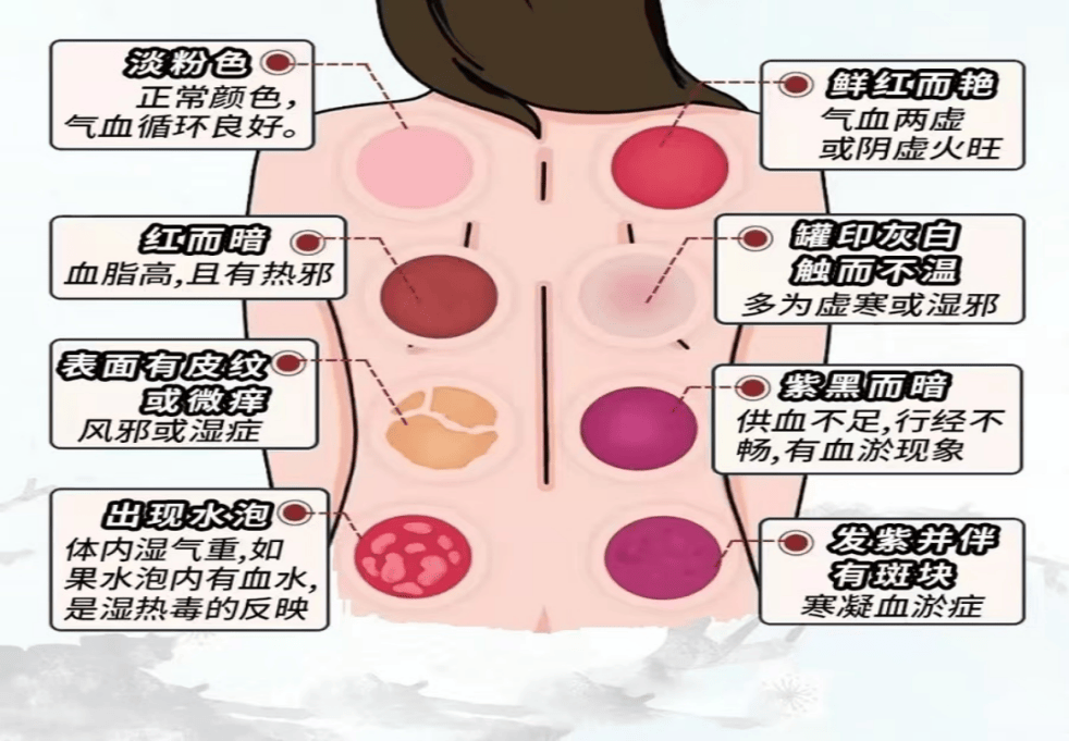 7天会消退,反复同一部位拔罐可能加重皮下损伤