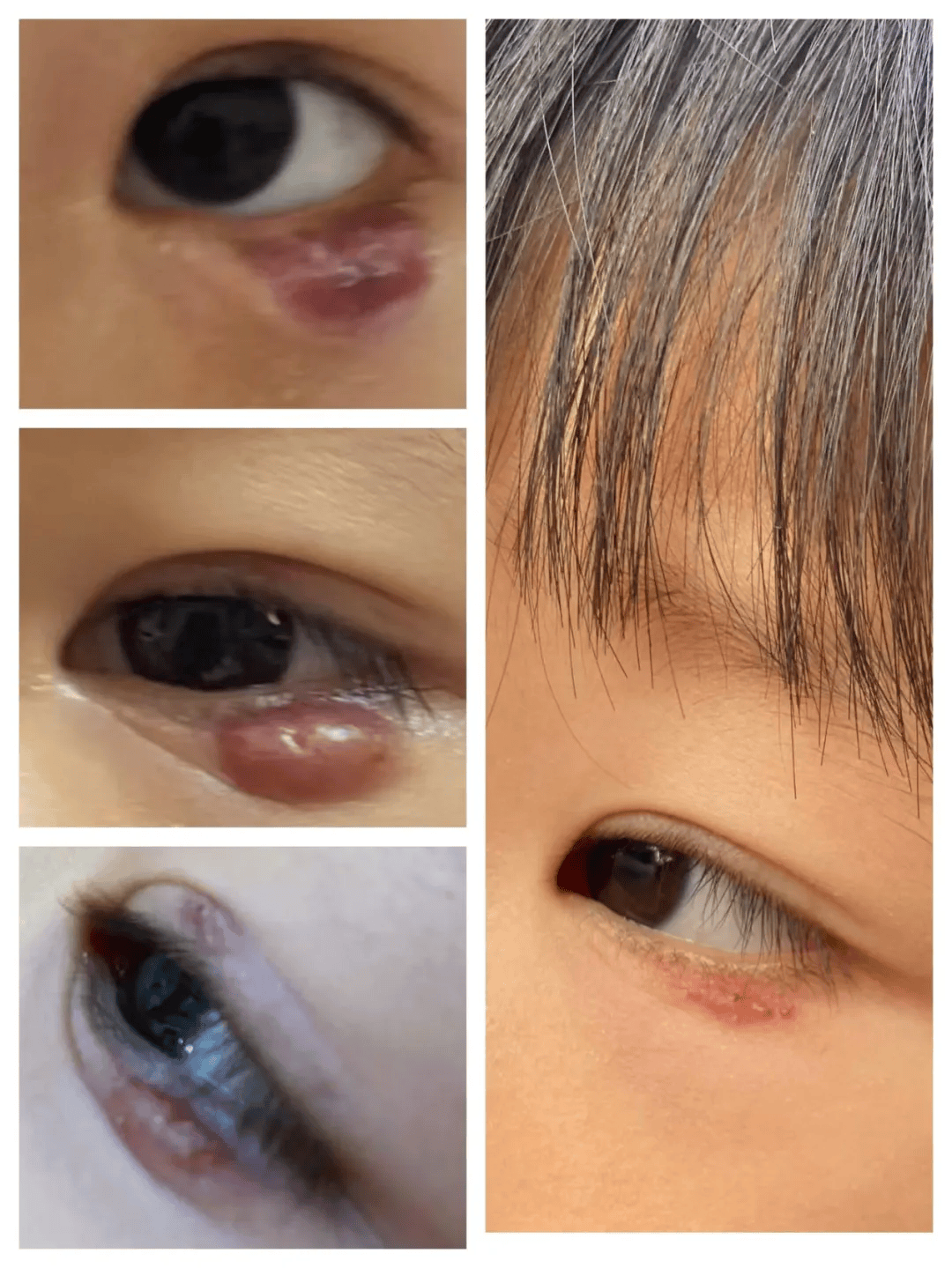 并且合并感染霰粒肿已经达到了2cm孩子的病情确实比较严重经检查找到
