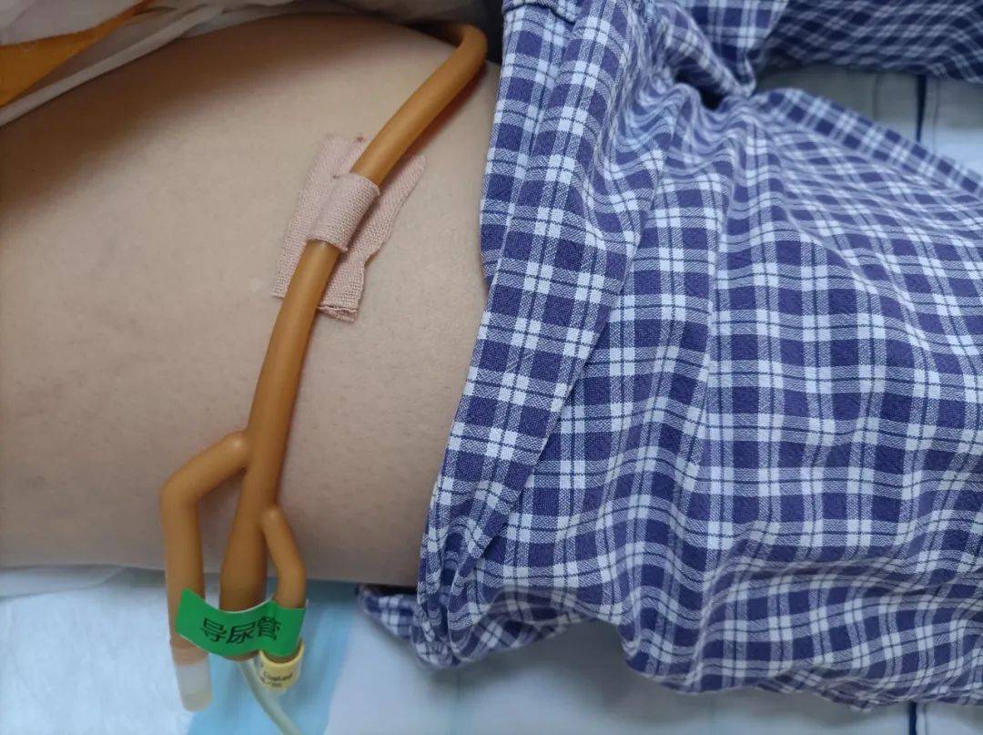 尿管居家护理攻略