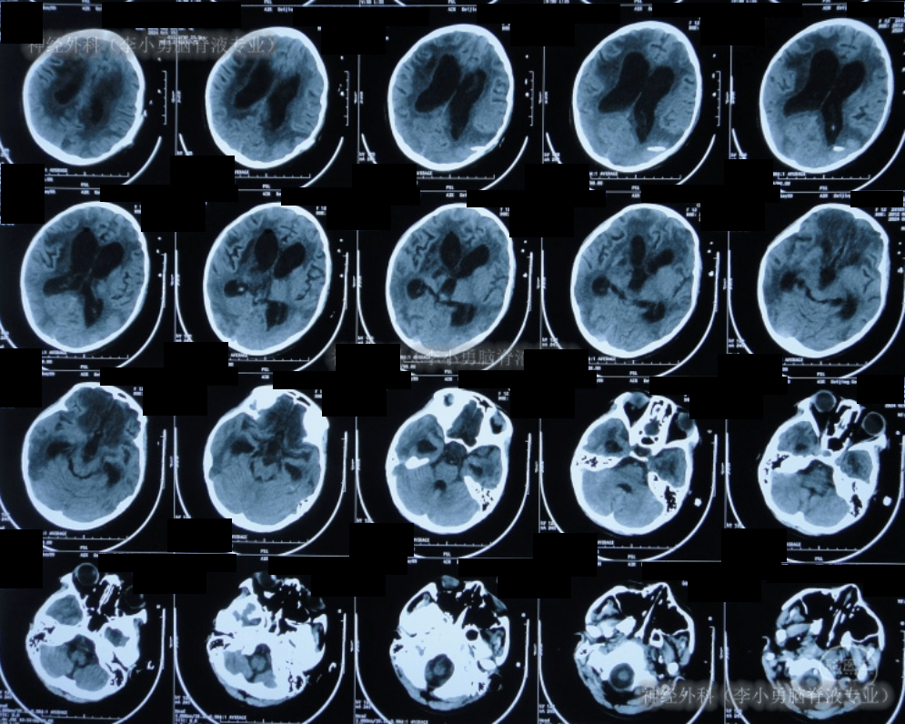 入院时头颅ct示双侧额顶枕叶及颞叶脑损伤,脑室系统扩张,内见点片状