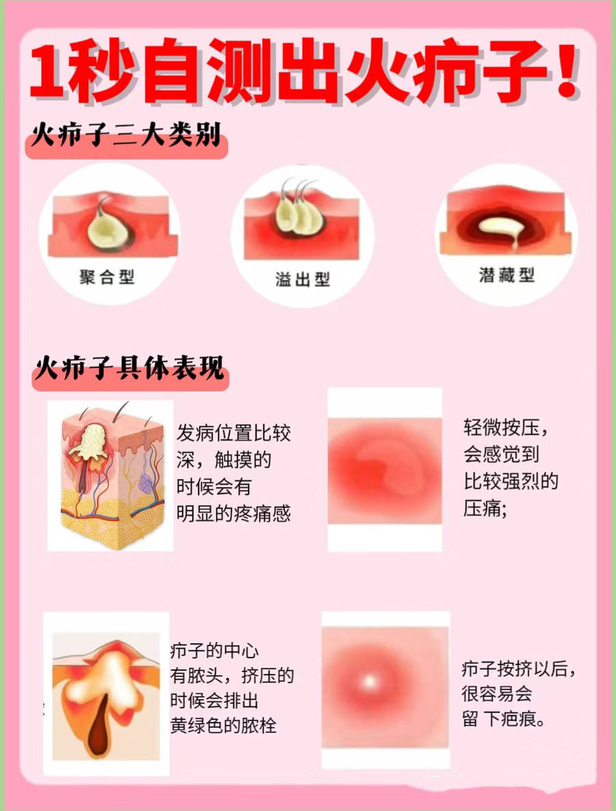 痘痘千万别乱挤!小心"小疖"变"大劫"