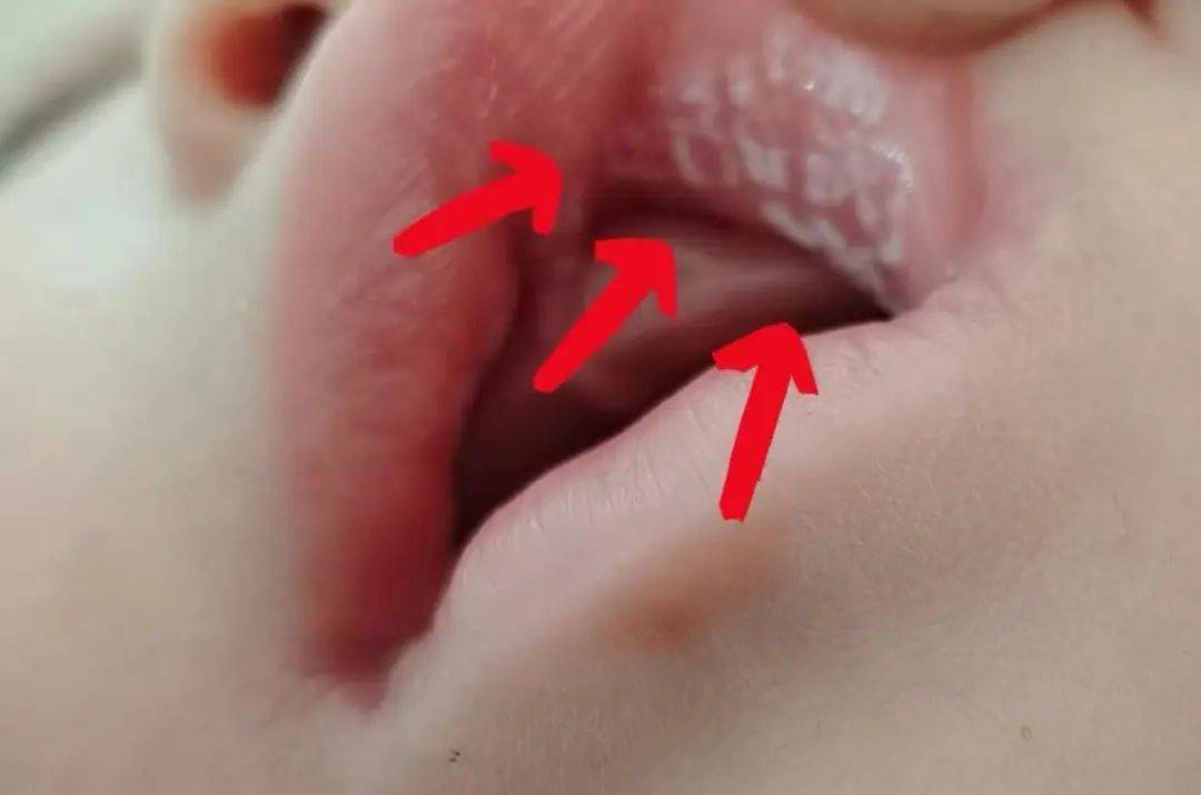 小宝宝嘴里的白膜,可不一定是奶渍哦!
